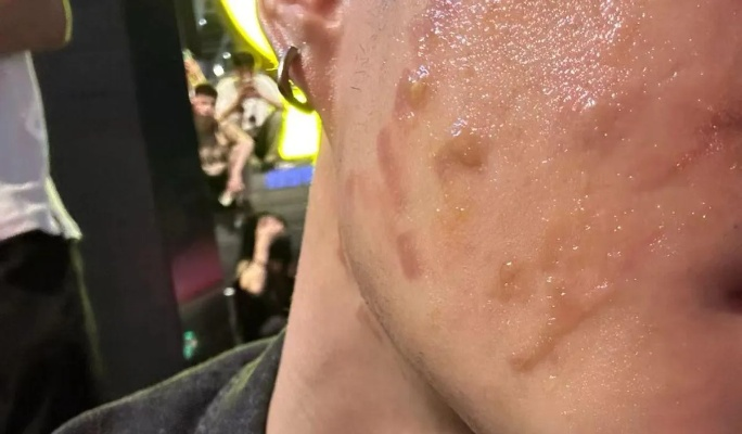 赫莲娜护理致脸烧伤，消费者权益如何守护？