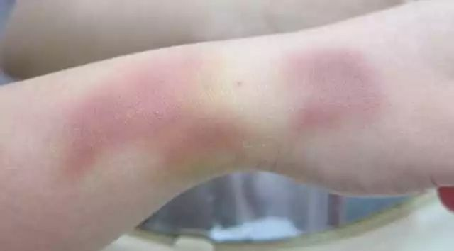 女生身体更容易出现淤青的原因分析