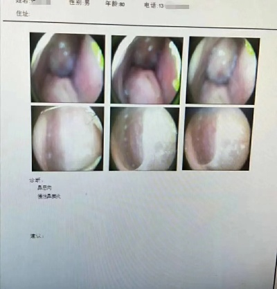 男子鼻窦炎多年，鼻内惊现三厘米长树枝，一段独特的医学经历