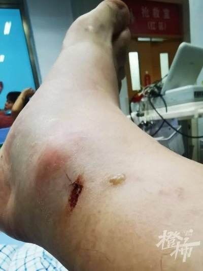 男子散步穿拖鞋遭毒蛇咬伤事件